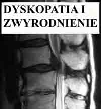 dyskopatia i zwyrodnienie