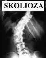 skolioza